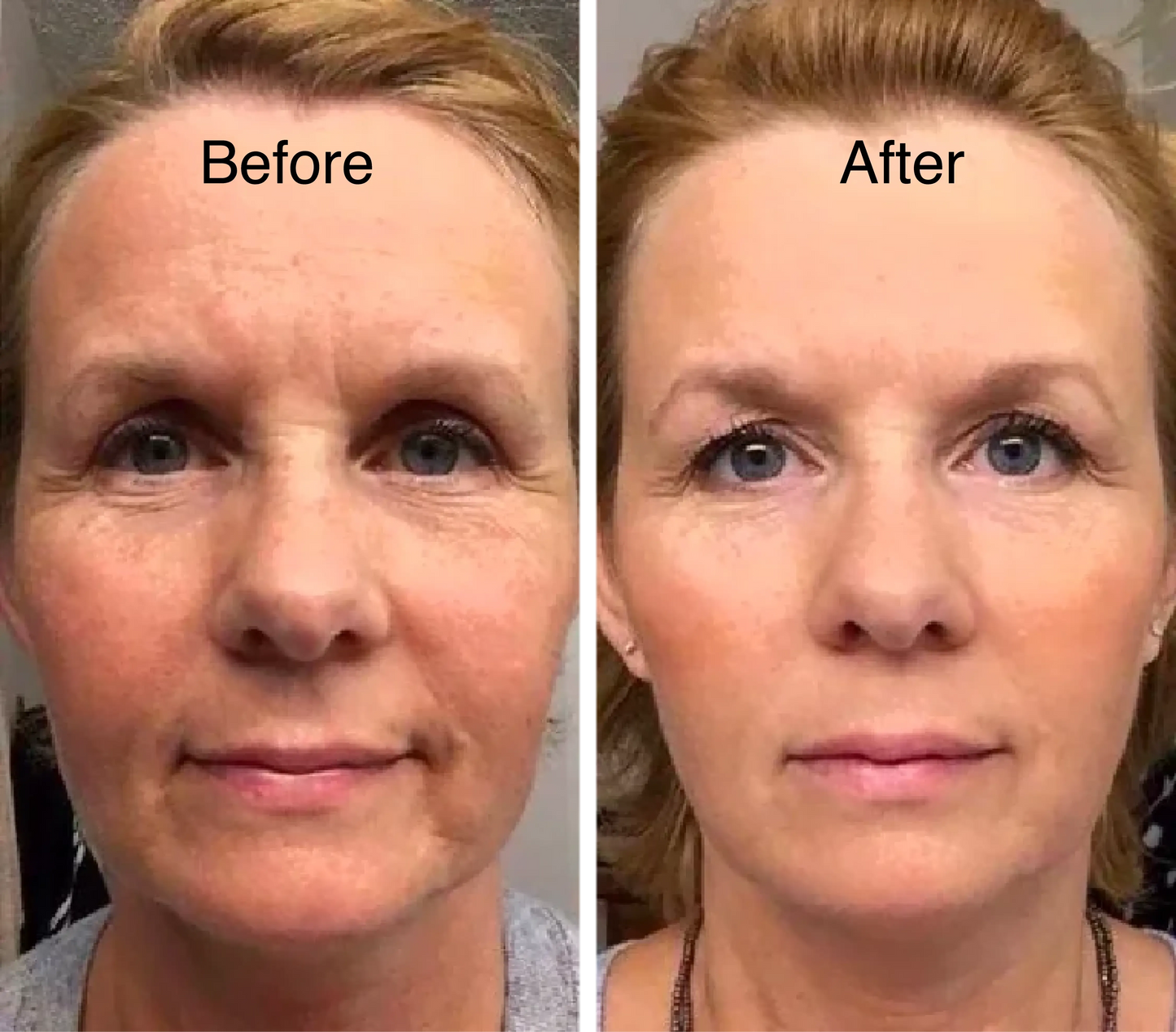 🔥Last Day Buy 2 Get 1 Free 🔥 Every day 5-minute daily ritual You can experience the effect of reducing swelling.